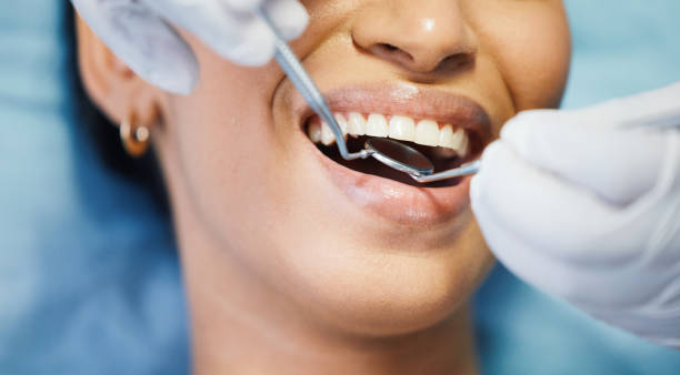 Best Emergency Dental Care for Broken or Chipped Teeth in Dash Point, WA