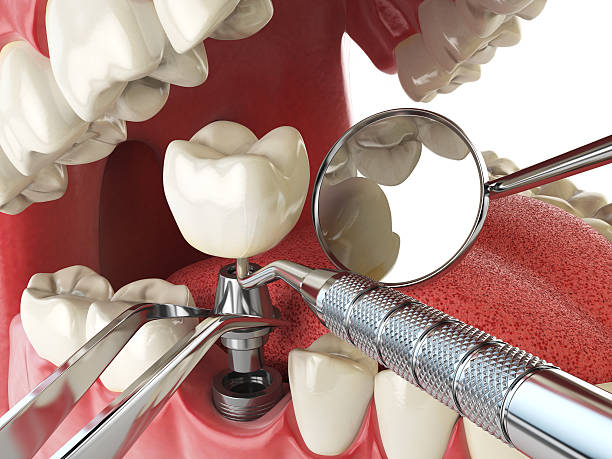 Best Emergency Gum Treatment in Dash Point, WA